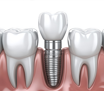 All on 4 Implant Treatments
