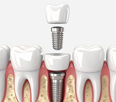 All on 4 Implant Treatments